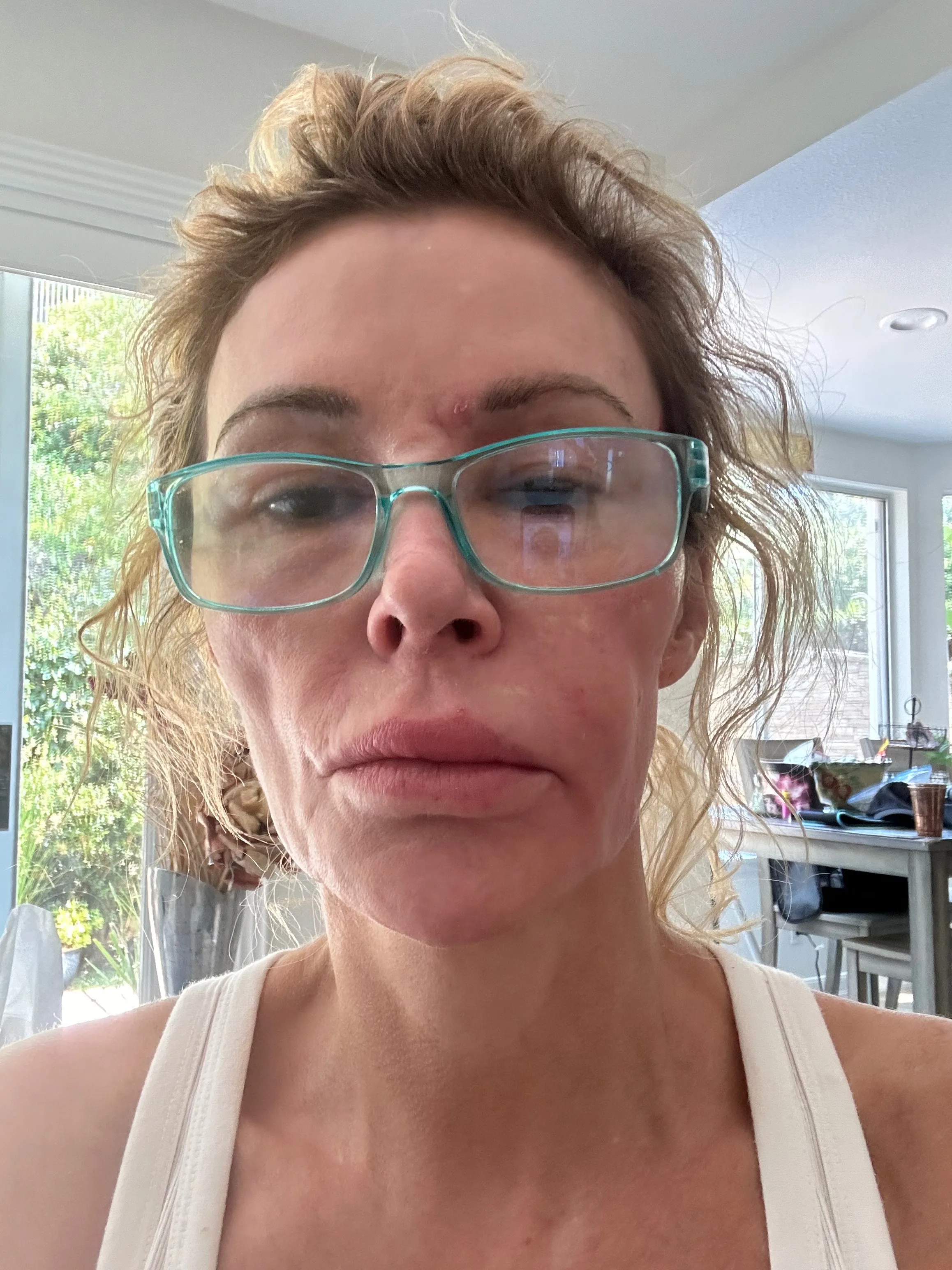Woman with glasses showing red, irritated skin on her face.